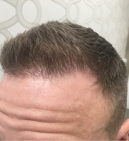 Image001a Png Hair Loss Forum Hair Transplant Forums