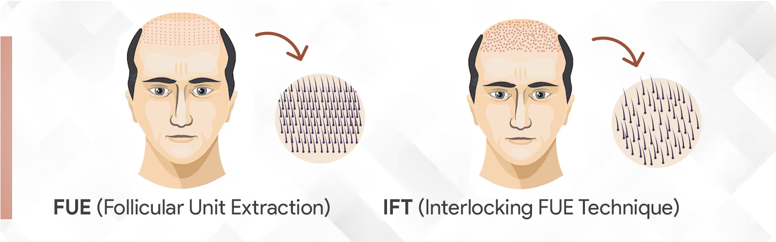 Interlocking fue technique: Natural Hair Results with IFT Technique
