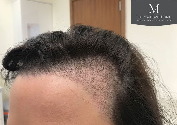 The Maitland Clinic 14 Days Post Op2 Jpg Hair Loss Forum Hair